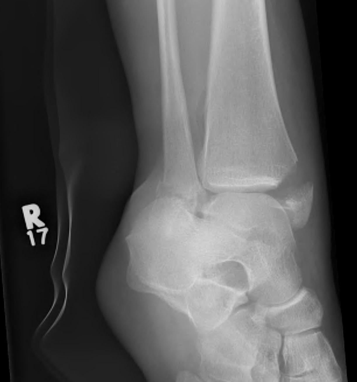 Ankle Fracture Supination Adduction